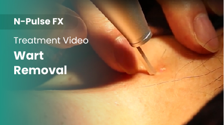 co2-surgical-fractional-laser-wart-removal