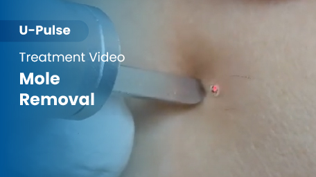 co2-surgical-fractional-laser-mole-removal