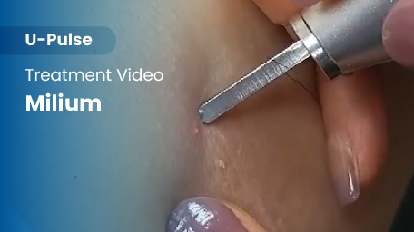 co2-surgical-fractional-laser-milium