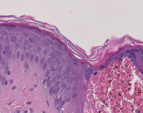 Q-Switched & Long-Pulsed Nd:YAG Laser_MLA LIOB (Skin Rejuvenation)