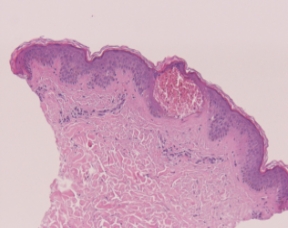 Q-Switched & Long-Pulsed Nd:YAG Laser_MLA LIOB (Skin Rejuvenation)