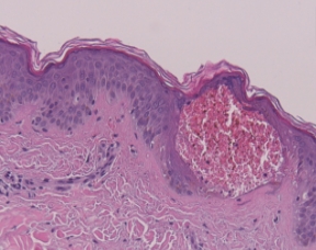 Q-Switched & Long-Pulsed Nd:YAG Laser_MLA LIOB (Skin Rejuvenation)