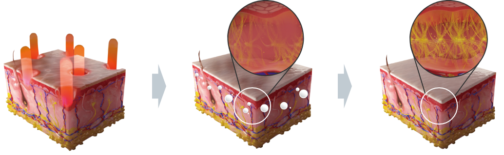 Q-Switched & Long-Pulsed Nd:YAG Laser_MLA LIOB (Skin Rejuvenation)