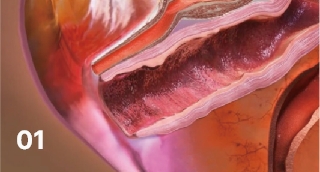 Vaginal remodeling laser_Vaginal Remodeling Procedure