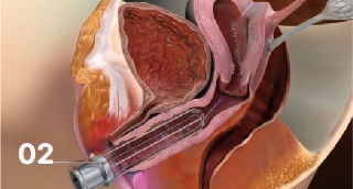 Vaginal remodeling laser_Vaginal Remodeling Procedure
