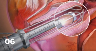 Vaginal remodeling laser_Vaginal Remodeling Procedure