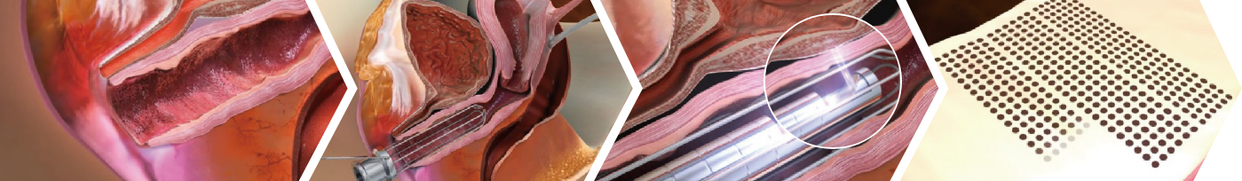 Vaginal remodeling laser_Vaginal Remodeling Procedure