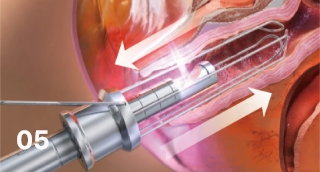 Vaginal remodeling laser_Vaginal Remodeling Procedure