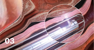 Vaginal remodeling laser_Vaginal Remodeling Procedure