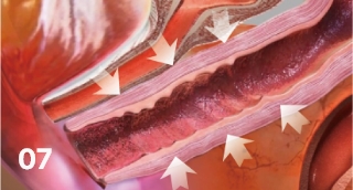 Vaginal remodeling laser_Vaginal Remodeling Procedure