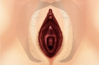 Vaginal remodeling laser_Improve vulva discoloration
