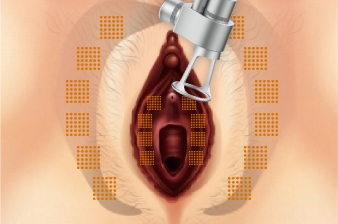 Vaginal remodeling laser_Improve vulva discoloration
