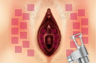 Vaginal remodeling laser_Improve vulva discoloration