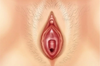 Vaginal remodeling laser_Improve vulva discoloration